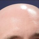 BALD
